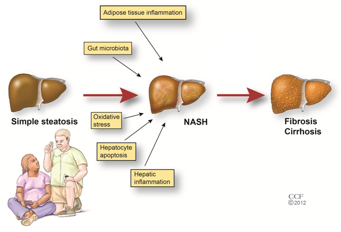 fatty_liver_img1.png