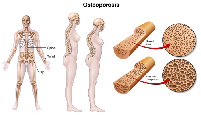 Osteoporosis_Causes.jpg