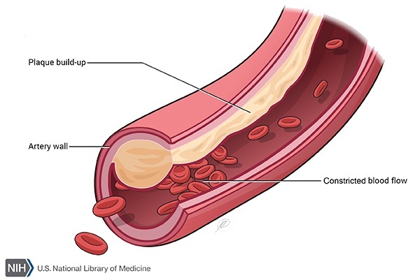 arteryplaque.jpg