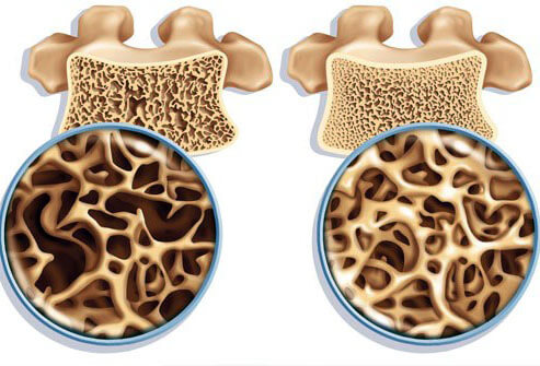 osteoporosis.jpg